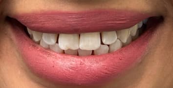 Smile makeover case 1 before treatment at Alpine Dental in Burke, VA