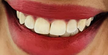 Smile makeover case 1 after treatment by Dr. Ashraghi in Burke, VA