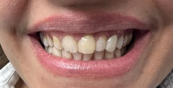 Smile makeover case 2 before treatment at Alpine Dental in Burke, VA