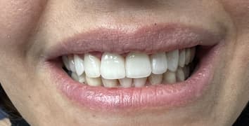 Smile makeover case 2 after treatment by Dr. Ashraghi in Burke, VA