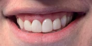 Smile makeover case 18 after treatment by Dr. Ashraghi in Burke, VA