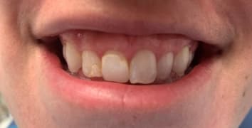 Smile makeover case 18 before treatment at Alpine Dental in Burke, VA