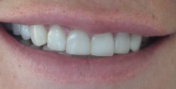 Smile makeover case 9 after treatment by Dr. Ashraghi in Burke, VA