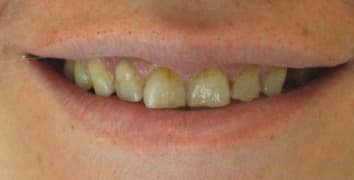 Smile makeover case 9 before treatment at Alpine Dental in Burke, VA