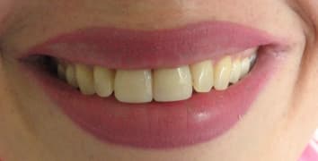 Smile makeover case 10 after treatment by Dr. Ashraghi in Burke, VA