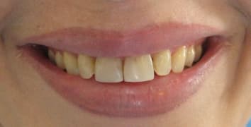 Smile makeover case 10 before treatment at Alpine Dental in Burke, VA