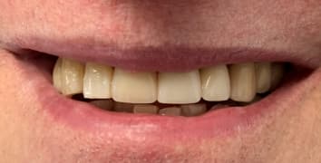 Smile makeover case 11 after treatment by Dr. Ashraghi in Burke, VA