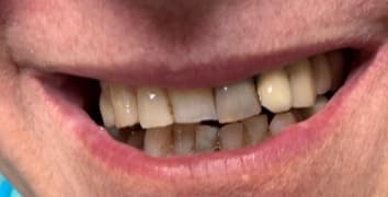 Smile makeover case 11 before treatment at Alpine Dental in Burke, VA