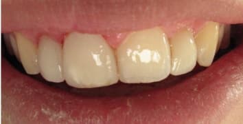 Smile makeover case 12 after treatment by Dr. Ashraghi in Burke, VA