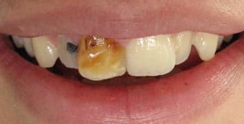 Smile makeover case 12 before treatment at Alpine Dental in Burke, VA