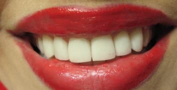 Smile makeover case 13 after treatment by Dr. Ashraghi in Burke, VA