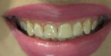Smile makeover case 13 before treatment at Alpine Dental in Burke, VA