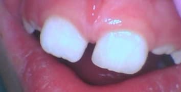 Smile makeover case 14 after treatment by Dr. Ashraghi in Burke, VA
