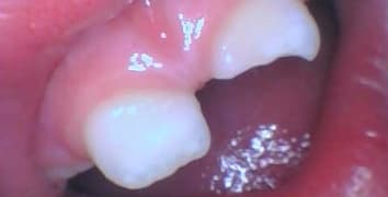 Smile makeover case 14 before treatment at Alpine Dental in Burke, VA