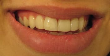 Smile makeover case 15 after treatment by Dr. Ashraghi in Burke, VA