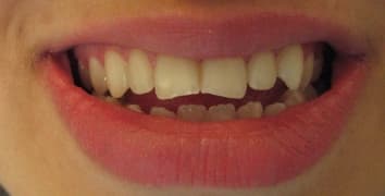 Smile makeover case 15 before treatment at Alpine Dental in Burke, VA