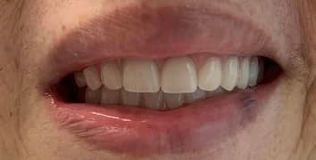 Smile makeover case 16 after treatment by Dr. Ashraghi in Burke, VA