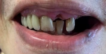 Smile makeover case 16 before treatment at Alpine Dental in Burke, VA