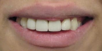 Smile makeover case 17 after treatment by Dr. Ashraghi in Burke, VA