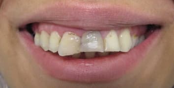 Smile makeover case 17 before treatment at Alpine Dental in Burke, VA