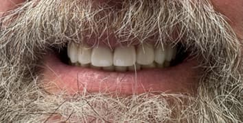 Smile makeover case 8 after treatment by Dr. Ashraghi in Burke, VA