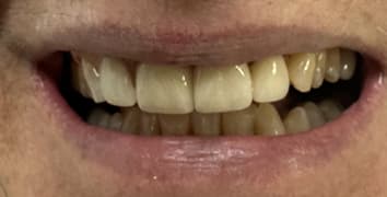 Smile makeover case 7 after treatment by Dr. Ashraghi in Burke, VA