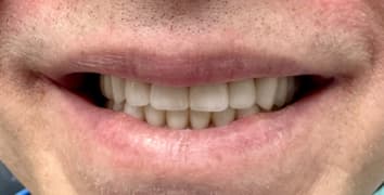 Smile makeover case 6 after treatment by Dr. Ashraghi in Burke, VA