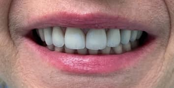 Smile makeover case 5 after treatment by Dr. Ashraghi in Burke, VA