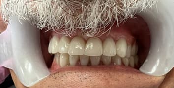 Smile makeover case 4 after treatment by Dr. Ashraghi in Burke, VA