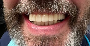 Smile makeover case 3 after treatment by Dr. Ashraghi in Burke, VA