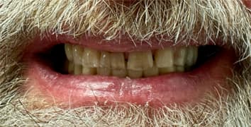 Smile makeover case 8 before treatment at Alpine Dental in Burke, VA