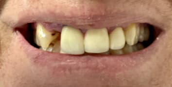 Smile makeover case 7 before treatment at Alpine Dental in Burke, VA