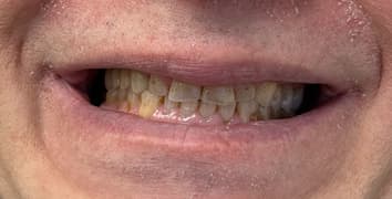 Smile makeover case 6 before treatment at Alpine Dental in Burke, VA