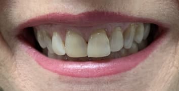 Smile makeover case 5 before treatment at Alpine Dental in Burke, VA
