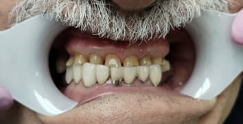 Smile makeover case 4 before treatment at Alpine Dental in Burke, VA