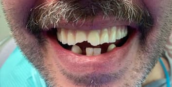Smile makeover case 3 before treatment at Alpine Dental in Burke, VA