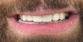 Smile makeover case 19 after treatment by Dr. Ashraghi in Burke, VA