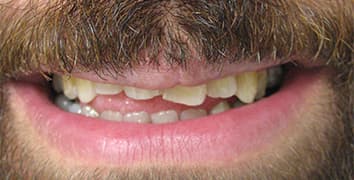 Smile makeover case 19 before treatment at Alpine Dental in Burke, VA