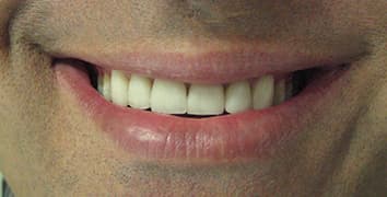 Smile makeover case 20 after treatment by Dr. Ashraghi in Burke, VA