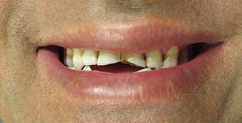 Smile makeover case 20 before treatment at Alpine Dental in Burke, VA