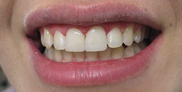 Smile makeover case 21 after treatment by Dr. Ashraghi in Burke, VA
