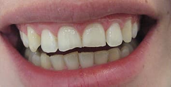 Smile makeover case 21 before treatment at Alpine Dental in Burke, VA