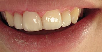 Smile makeover case 22 after treatment by Dr. Ashraghi in Burke, VA