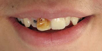 Smile makeover case 22 before treatment at Alpine Dental in Burke, VA