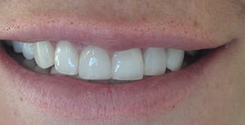 Smile makeover case 23 after treatment by Dr. Ashraghi in Burke, VA
