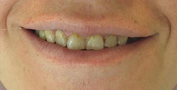 Smile makeover case 23 before treatment at Alpine Dental in Burke, VA