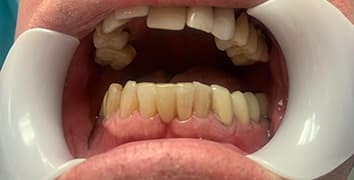 Smile makeover case 24 after treatment by Dr. Ashraghi in Burke, VA