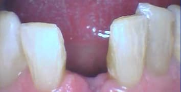 Smile makeover case 24 before treatment at Alpine Dental in Burke, VA