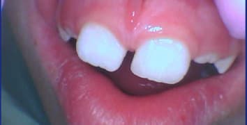 Smile makeover case 25 after treatment by Dr. Ashraghi in Burke, VA