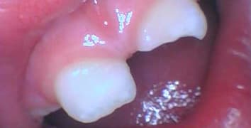 Smile makeover case 25 before treatment at Alpine Dental in Burke, VA